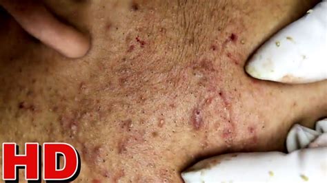 The most common symptoms of acne conglobata are Deeply inflamed abscesses in the skin; Blackheads that are typically found on the buttocks, . . Blackheads extreme